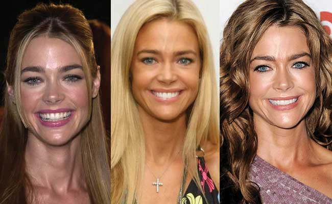 Denise Richards Plastic Surgery Before And After Pictures 2018